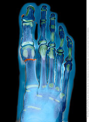 FRACTURED FOOT X-RAY