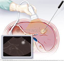 RADIOFREQUENCY ABLATION
