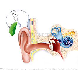 COCHLEAR IMPLANT  ILLUSTRATION