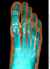 FRACTURED FOOT X-RAY