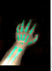 INFANT HAND  X-RAY