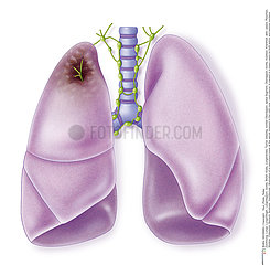 LUNG CANCER  DRAWING