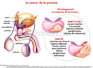CANCER OF THE PROSTATE  DRAWING