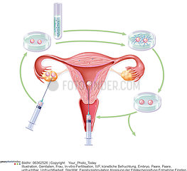 IVF  ILLUSTRATION Illustration