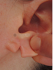 Split ear lobe