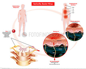 Varizella Zoster Virus