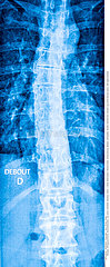 SCOLIOSIS  X-RAY