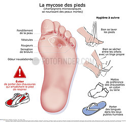 MYCOSIS ON A FOOT  DRAWING