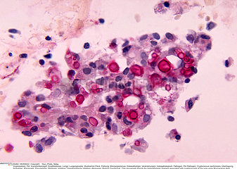 Cryptococcosis Imagerie