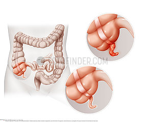 APPENDICITIS  DRAWING