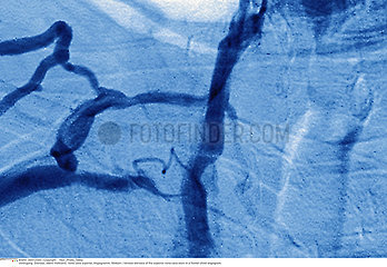 VENOUS STENOSIS  ANGIOGRAPHY