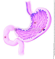 GASTRIC ULCER