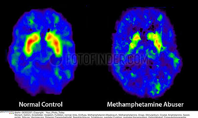 Brain Scan - Methamphetamine