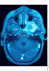 NEURINOMA MRI