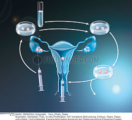 IVF  ILLUSTRATION Illustration