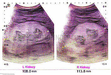 kidneus ultrasound