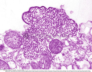 NIPAH VIRUS INFECTION Imagerie
