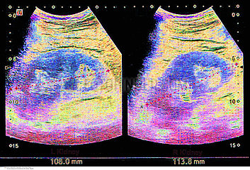 kidneys ultrasound