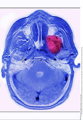 NEURINOMA MRI