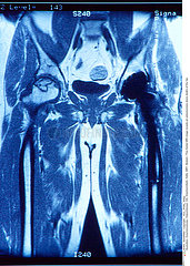 OSTEONECROSIS OF THE HIP Imagerie