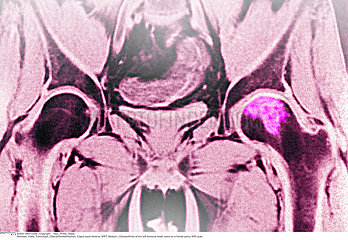 HIP OSTEOARTHRITIS  MRI