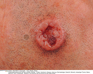 SQUAMOUS CELL CARCINOMA