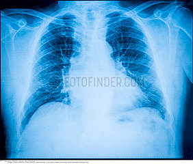 LUNG  X-RAY