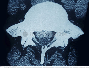HERNIATED DISK  CT SCAN