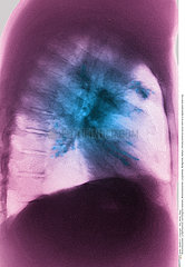 LUNG CANCER X-RAY