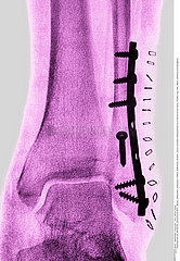 Osteosynthesis on a fracture of the fibula