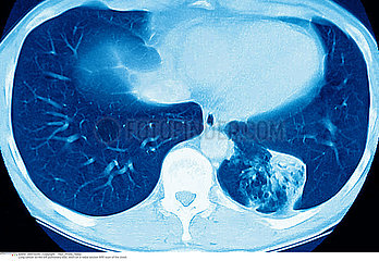 LUNG CANCER  MRI