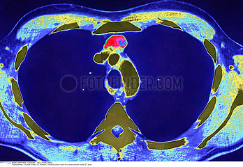 THYMUS CANCER  CT SCAN