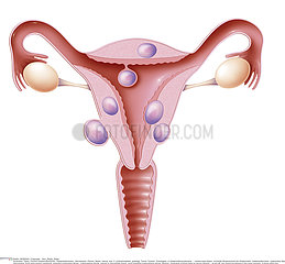 Illustration Gebärmutterfibrom
