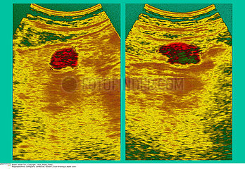 PEPTIC ULCER  SONOGRAPHY Imagerie
