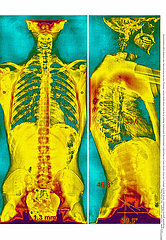 SPINAL COLUMN  X-RAY