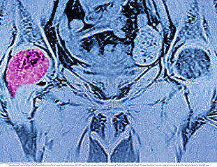 BONE METASTASIS  MRI