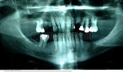 TOOTH  X-RAY
