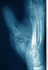 FRACTURED HAND  X-RAY