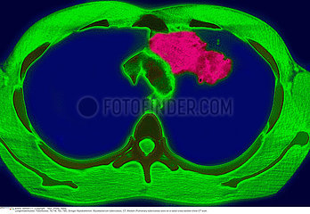 PULMONARY TUBERCULOSIS  CT-SCAN
