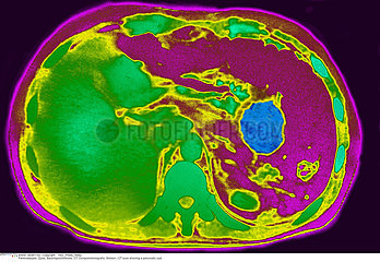 PANCREATIC CYST  CT SCAN Imagerie