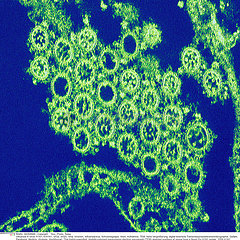 INFLUENZA A H1N1 VIRUS Imagerie