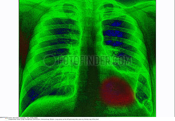 LUNG CANCER  X-RAY