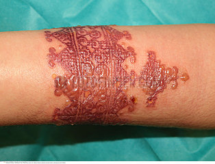 R?action allergique importante apr?s un tatouage au henn?