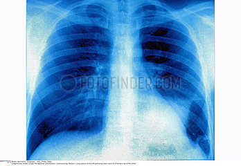 LUNG CANCER  X-RAY