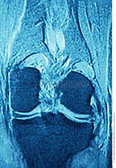 Normal knee MRI