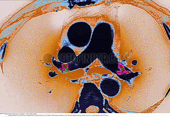 PULMONARY EMBOLISM  CT SCAN