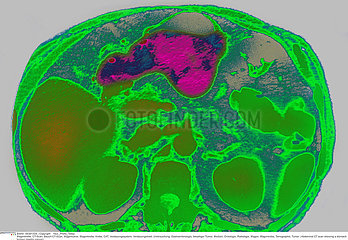 STOMACH CANCER  CT SCAN Imagerie