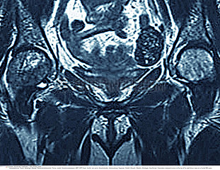 BONE METASTASIS  MRI