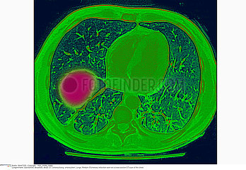 PULMONARY INFARCTION CT SCAN