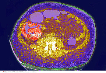 COLON CANCER CT SCAN